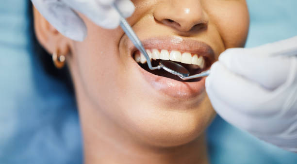 Best Knocked-Out Tooth (Avulsed Tooth) Treatment in North Shore, VA